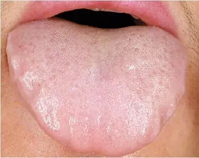从舌头看健康:你是这七种体质中的哪一种?(图6) 从舌头看健康:你是这七种体质中的哪一种?(图6)